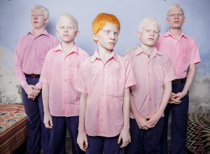 blind albino boys west bengal india